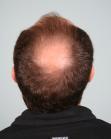 Before Hair Transplant&nbsp;Midscalp